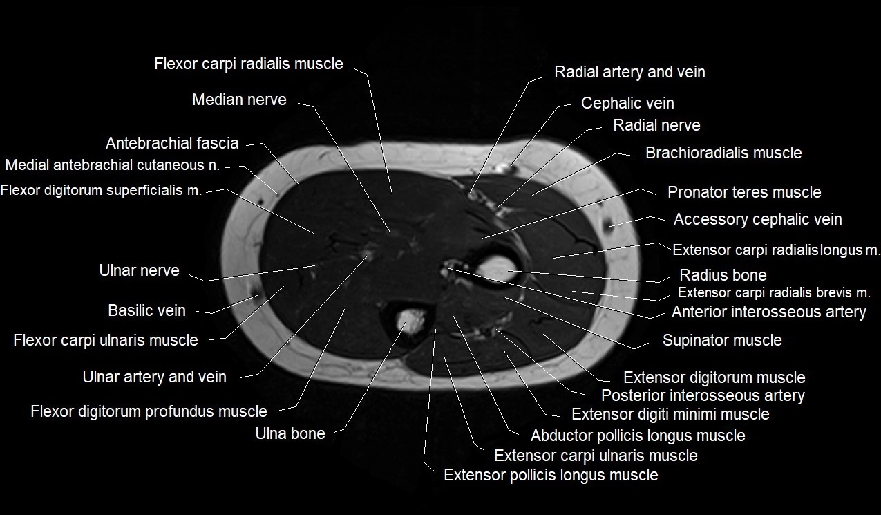 MRI 3T forearm axial cross sectional anatomy image 20.webp
